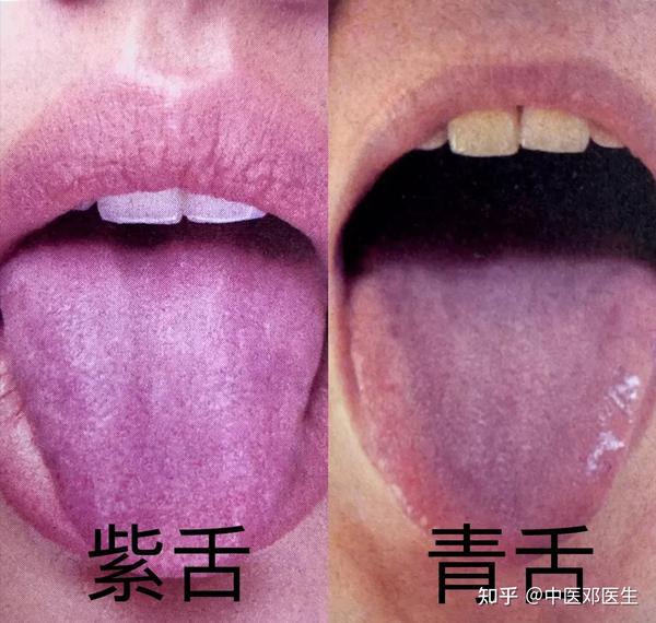 注意舌头有这七种舌象信号,关乎你的身体健康 - 知乎