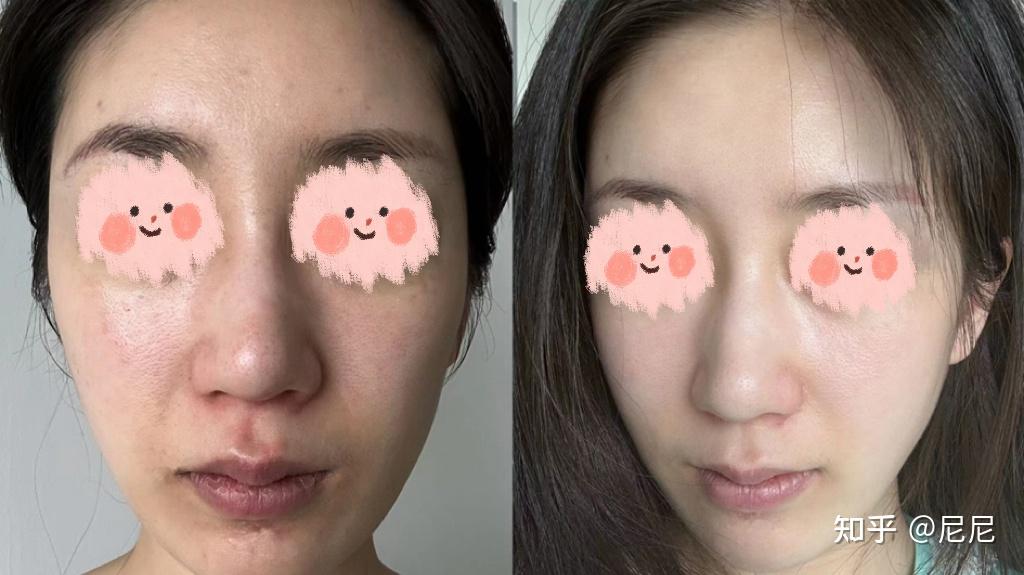 90后老阿姨该如何有效抗老？用A醇有用吗？敏感肌抗老怎么做？ - 知乎