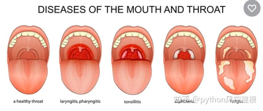 一图读懂慢性咽喉炎Chronic pharyngitis - 知乎