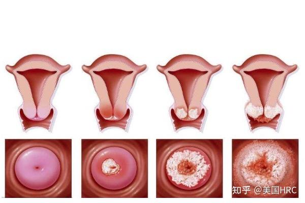 宫颈白斑图片图库图片