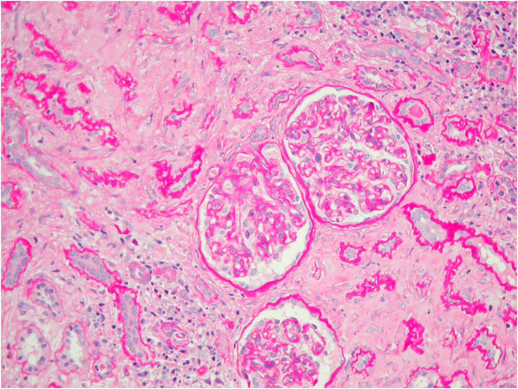 巴尔干肾病马兜铃酸肾病与中草药肾病