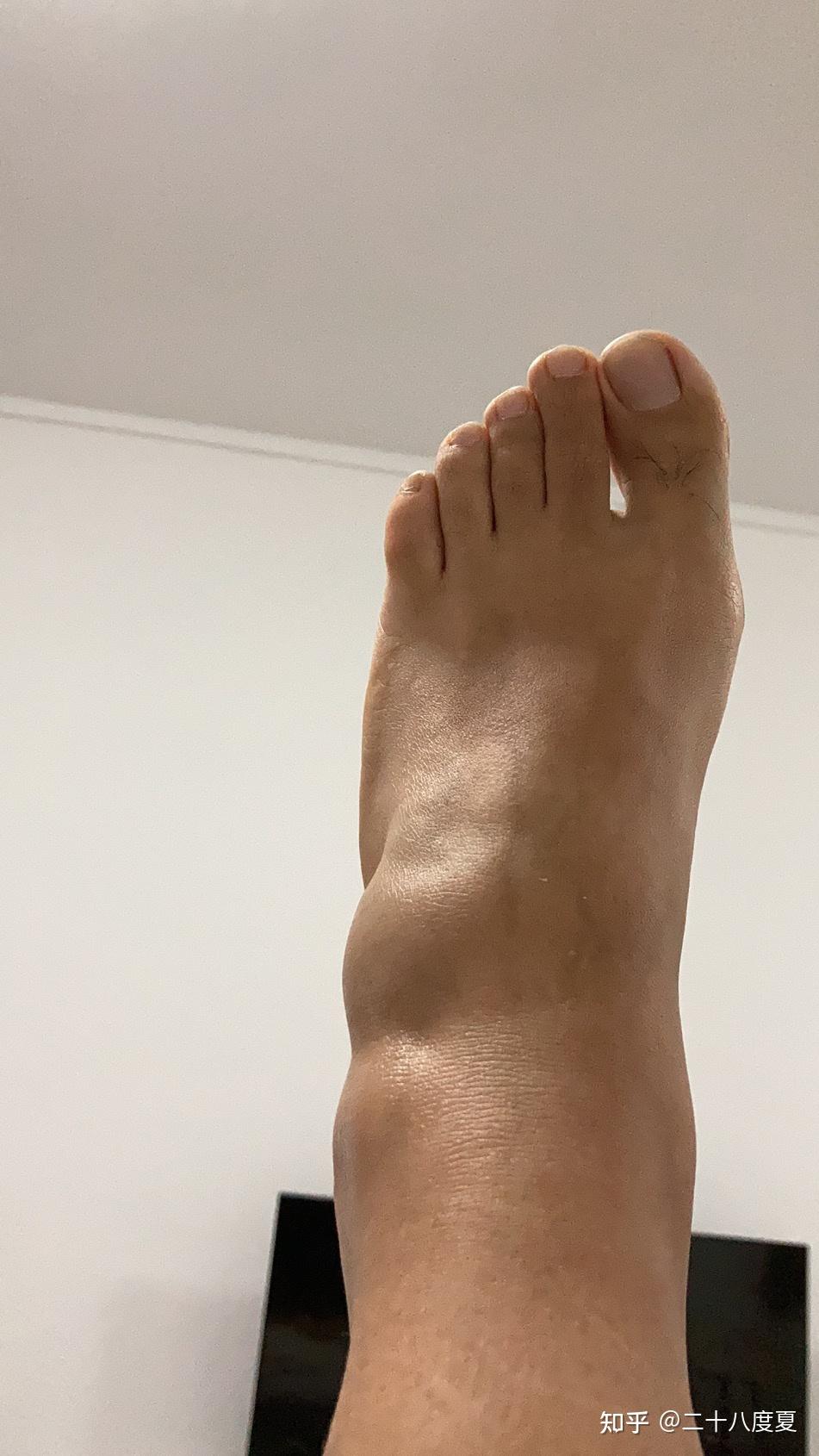 左距骨撕脱性骨折的恢复和生活