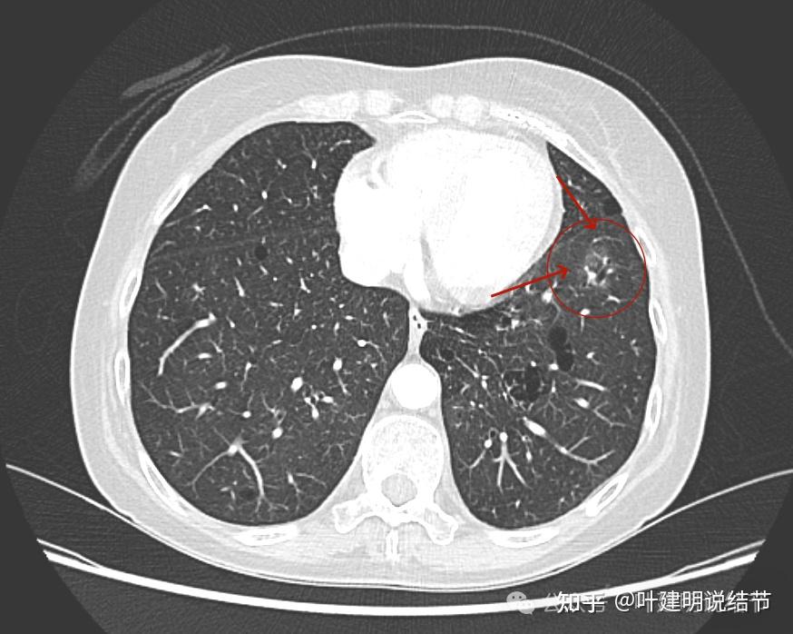 跨國問診來自澳大利亞的肺結節問診