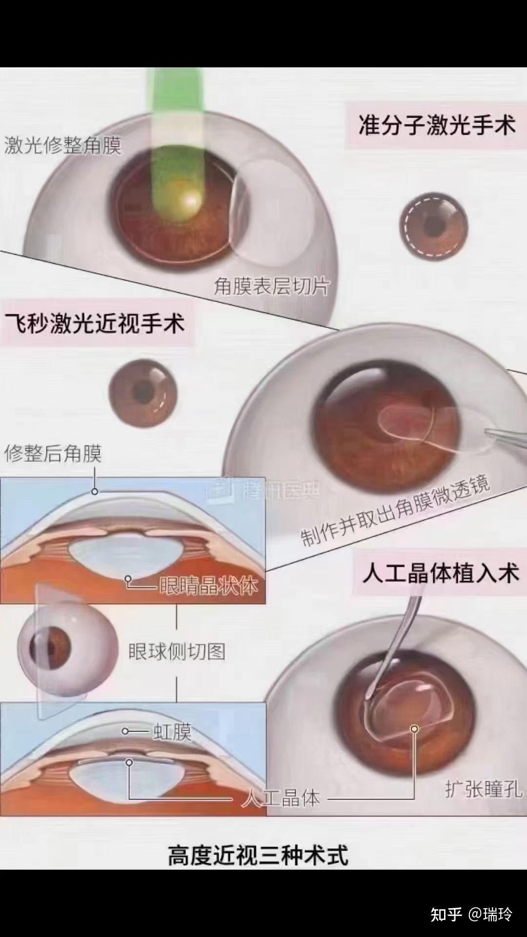 近视手术后多久可以正常用眼_厦门大学附属厦门眼科中心