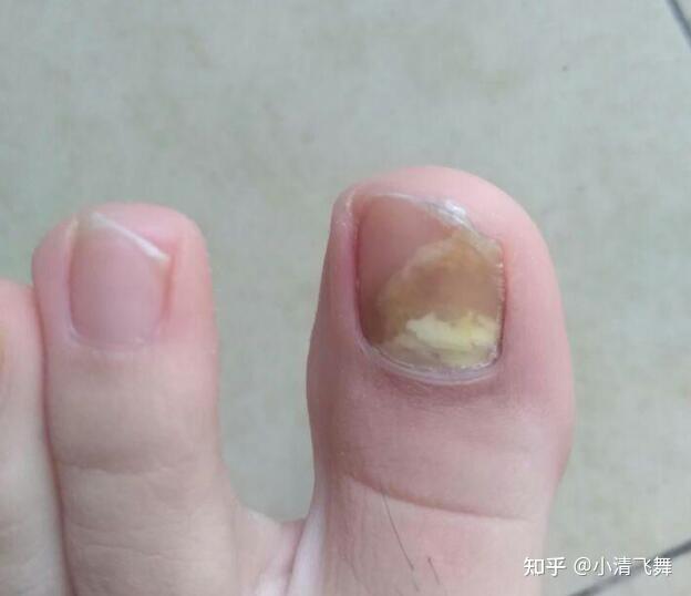 治疗灰指甲最有效的方法是什么全程记录我的灰指甲治疗过程