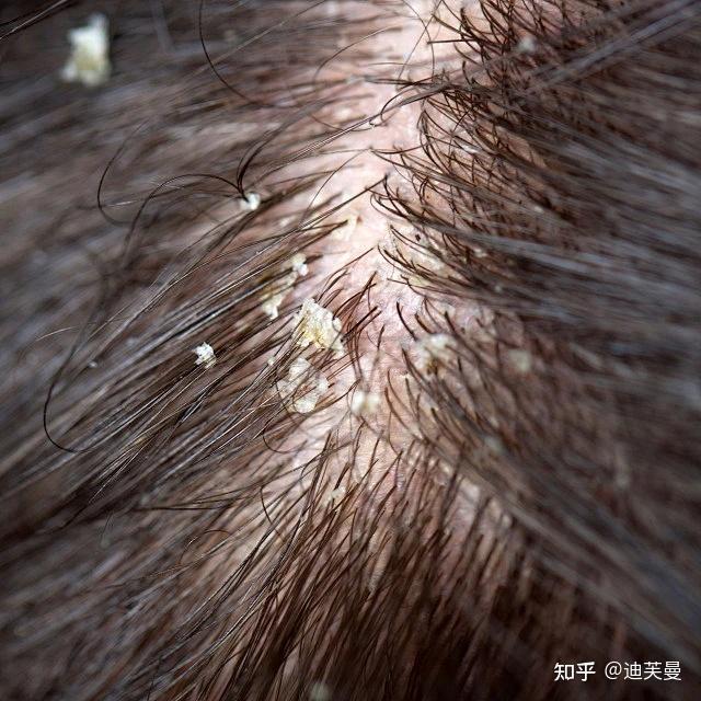 皮肤病:如脂溢性皮炎和头癣,这些皮肤病都可能导致头皮屑增多