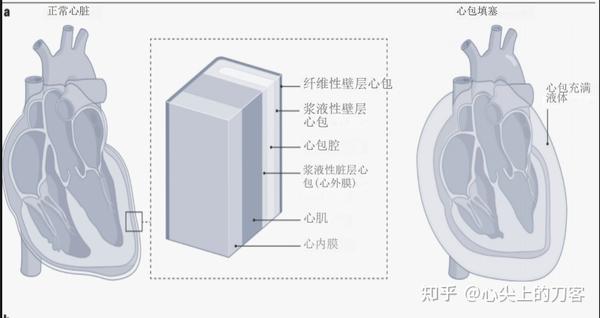 心包填塞 - 知乎