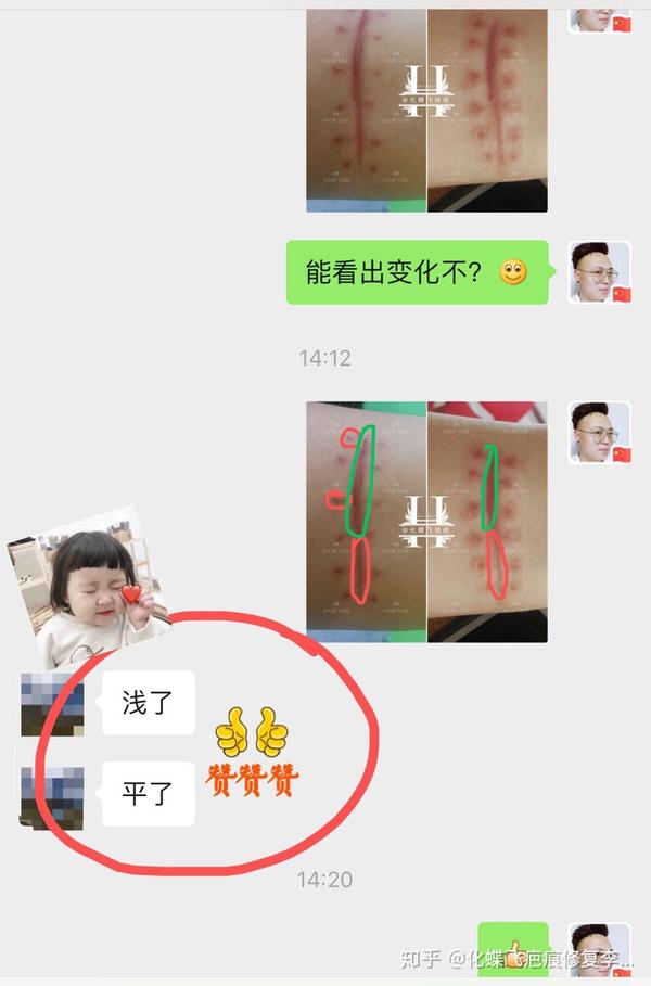 壁纸刀划伤增生疤痕 用中药代谢一次平了浅了 知乎