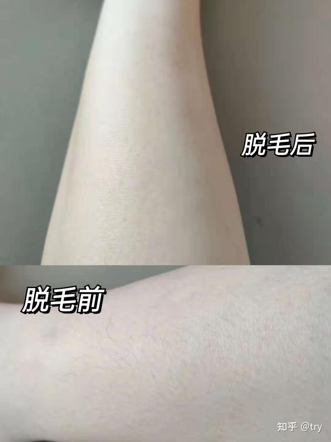 植发后可以脱毛(植发后可以剃寸头吗)