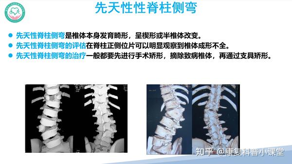 特发性脊柱侧弯的诊疗策略 - 知乎