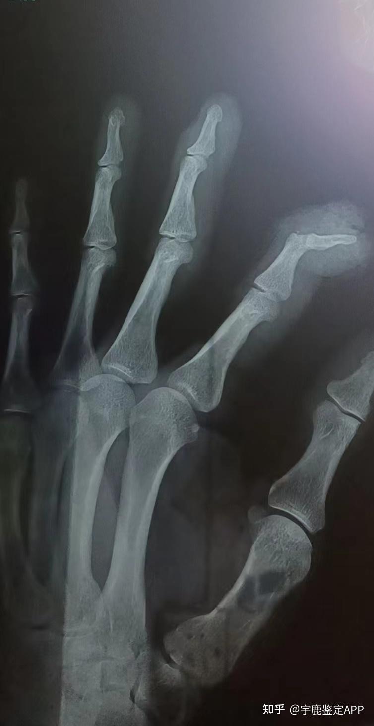 工伤指骨骨折想马上知道能评几级！ - 知乎