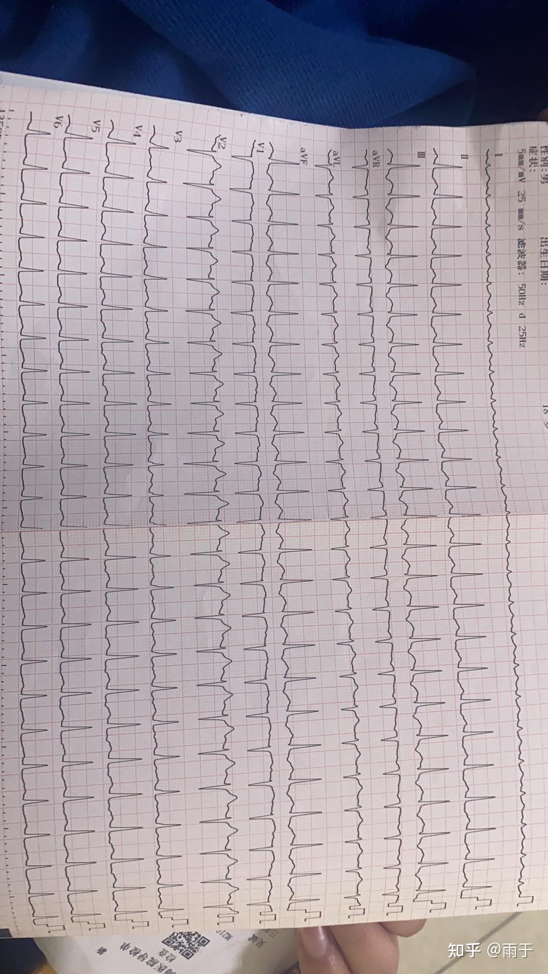 心跳过快心电图图片