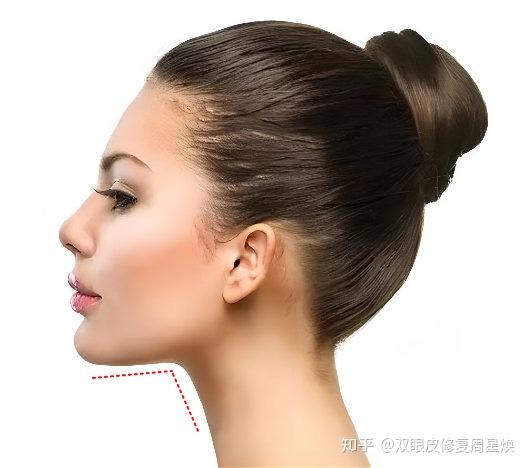 周星焕吸脂如何拥有一个比较理想的颏颈角