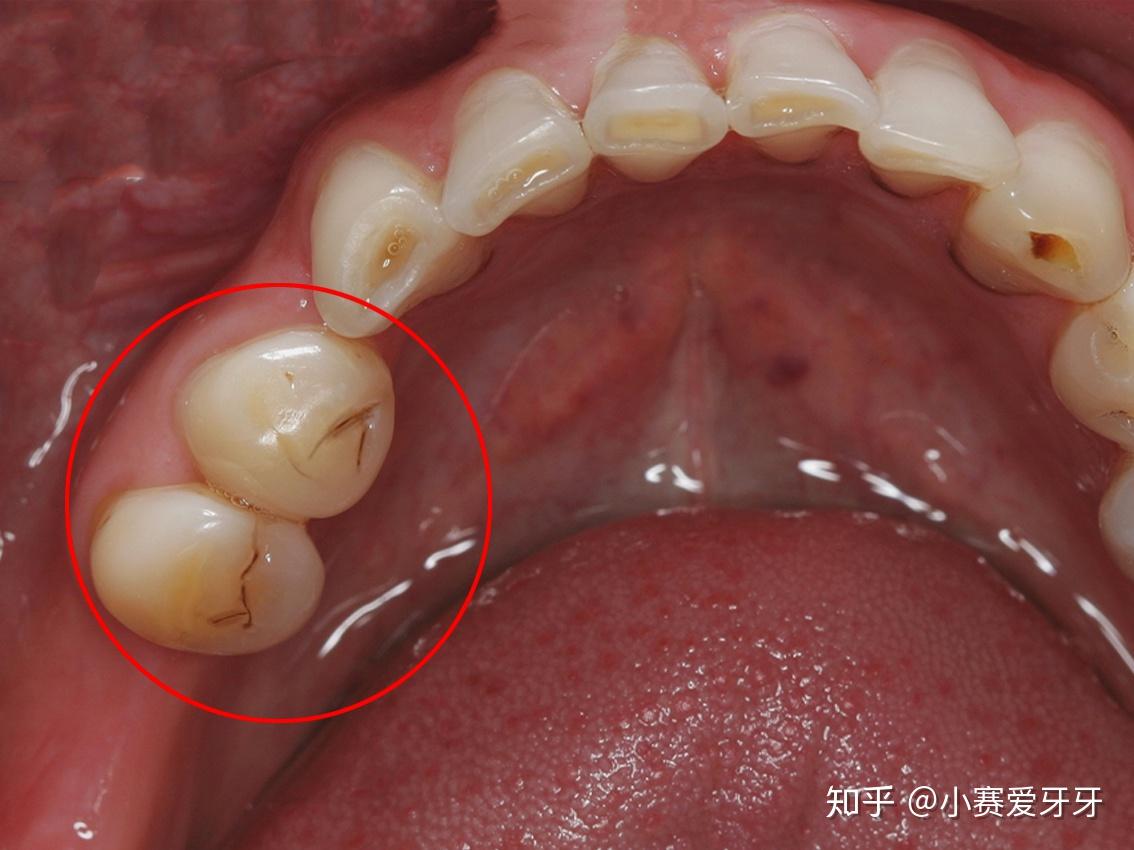 牙齿上的黑线究竟是什么？__中国医疗