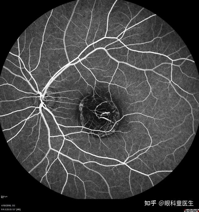 脉络膜透见图片