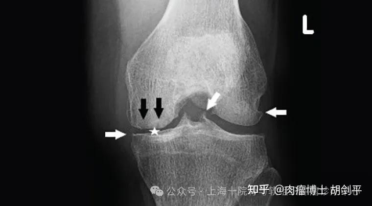 成人外生骨疣——骨刺还是骨质增生 - 知乎