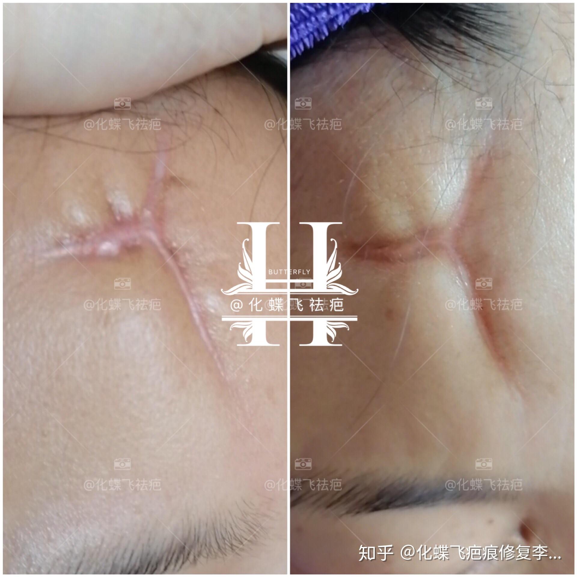 受伤缝针视频全过程 v2-fd31935819ae737ca082929f0677eeab_r.jpg