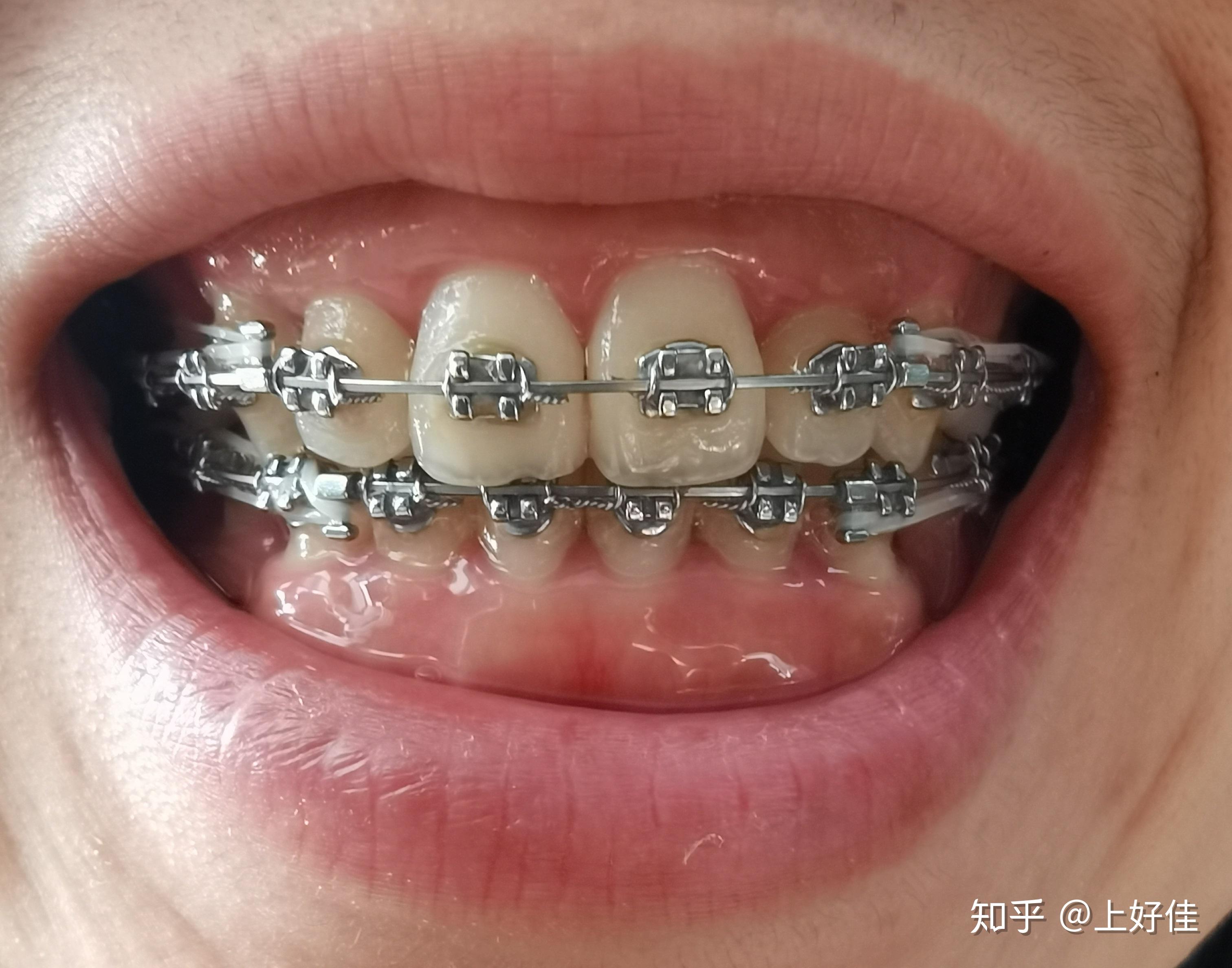 一更:12月29号去复诊,紧了紧结扎丝,1月7号托槽被花生米咯掉了一个,1