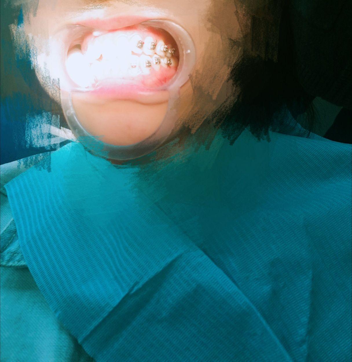 到地儿后,先是给我磨了磨牙齿,由于我是闭眼的