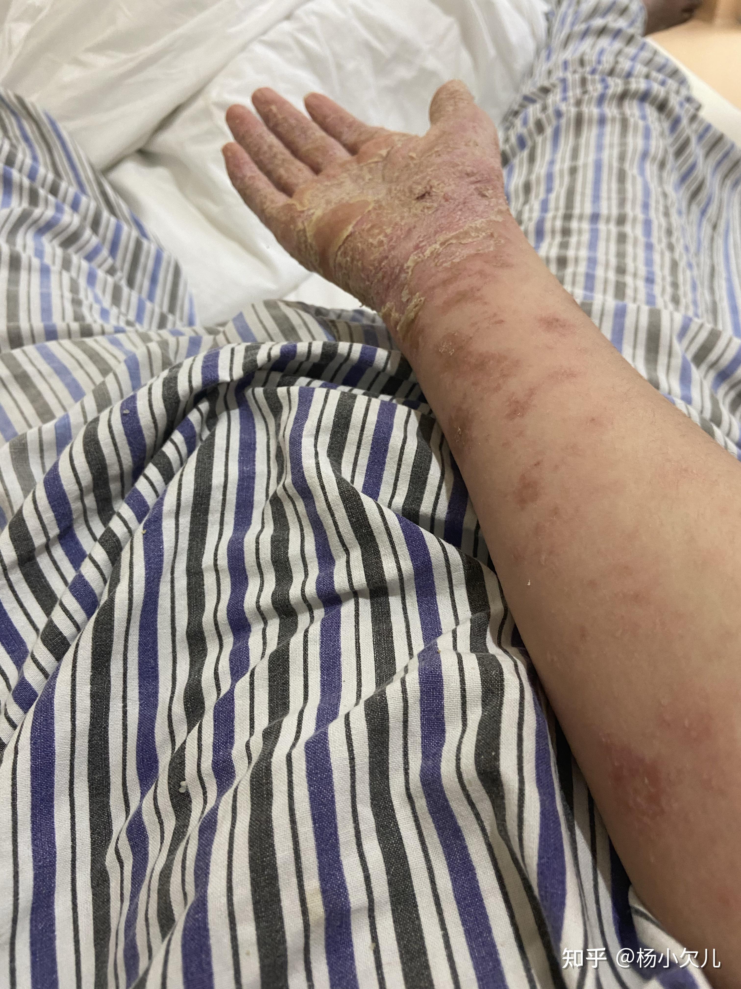 生物制剂治疗强直引发银屑病