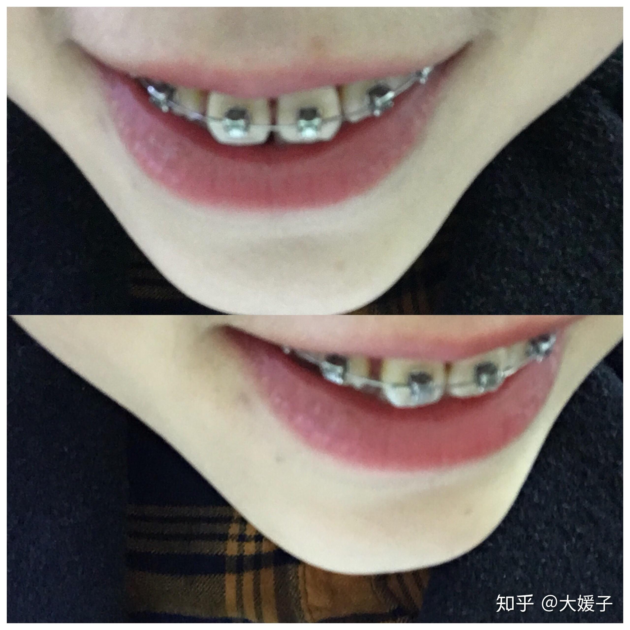 记录23岁才决定去正畸的稀疏小牙齿的日常 - 知乎