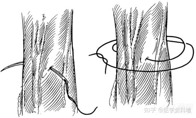 外科常見縫合方法
