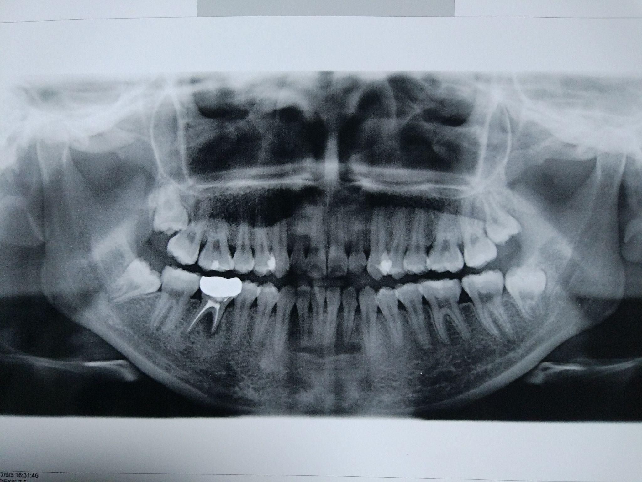 牙医碰见最烂的牙有多烂?