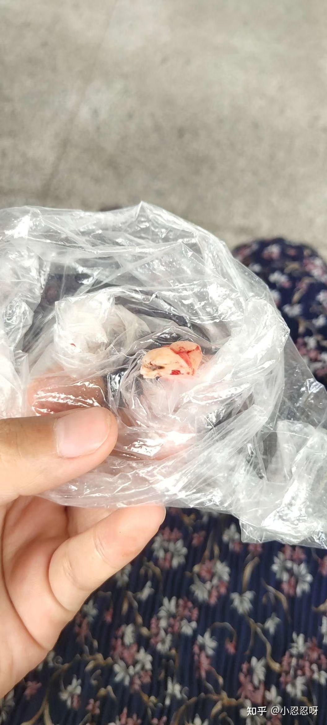 为了我的后槽牙能够健康长寿我不得不来到医院取下我的智齿(以下有实