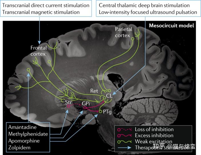 四分之一无反应的脑损伤患者可能有意识 1 in 4 Unresponsive People with Brain Injuries May ...