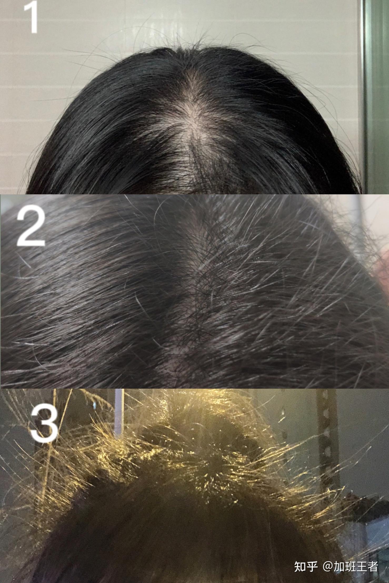 如何使自己的头发变得浓密?有什么特猛的让头发变多的方法? - 知乎