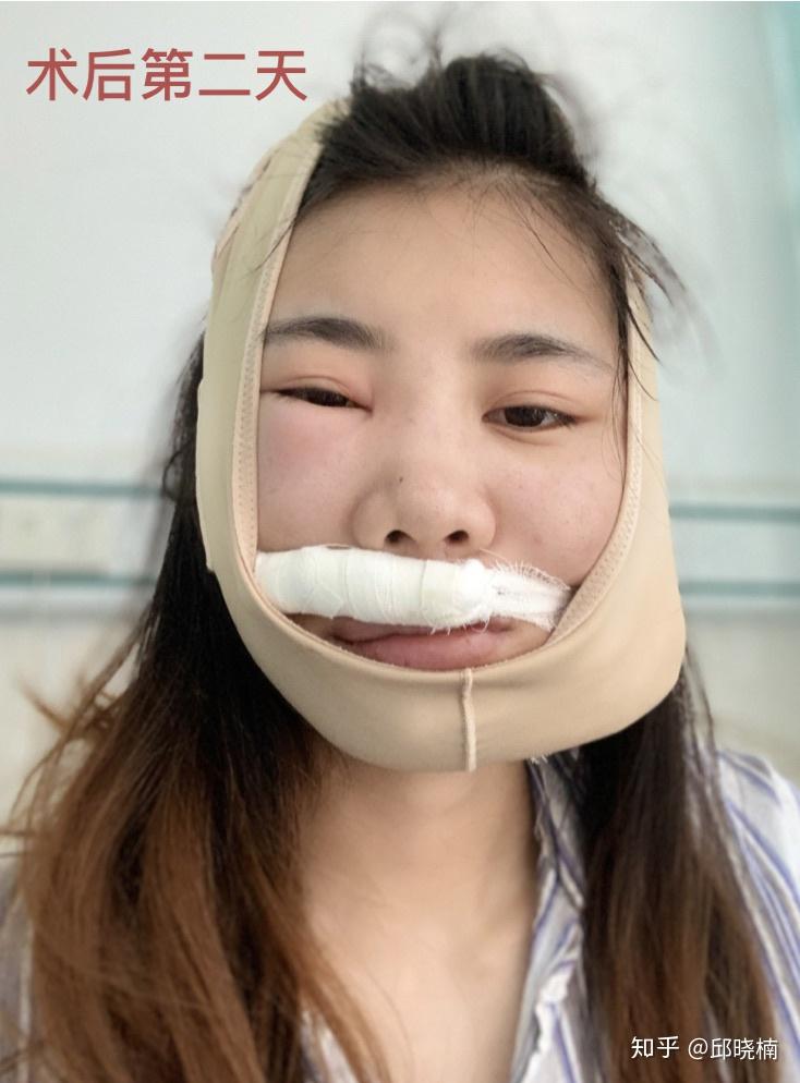 三颗牙根管 上颌骨囊肿 多生牙是一种怎么样的体验? - 知乎