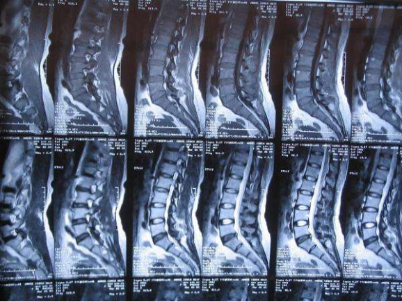 腰椎间盘突出症有必要清楚马尾神经综合征的严重危害