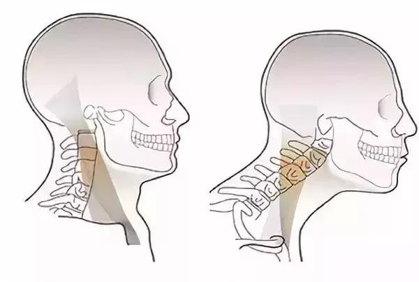 胸锁乳突肌拉伤图片