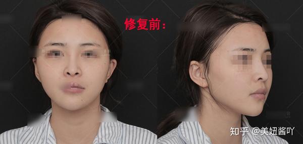 国内热门鼻修复医生最全测评 附案例 国内鼻修复最好的医院 双偶网