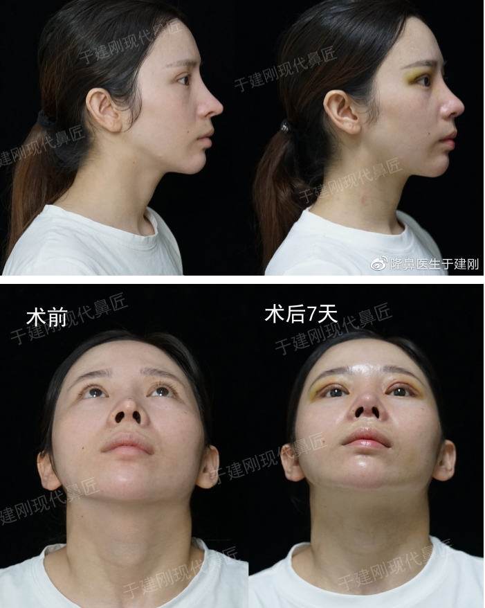 关于鼻尖整形你了解多少 知乎 关于鼻尖整形你了解多少 知乎
