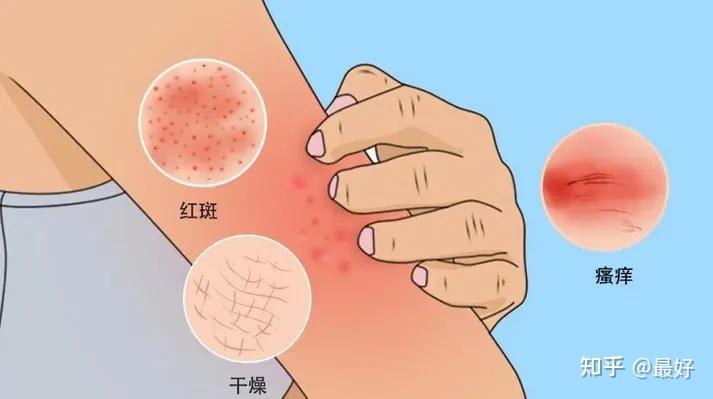 过敏原检查的是什么? - 知乎