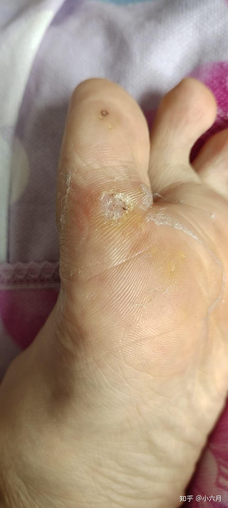 关于跖疣用蒜敷了十三天的结果带图