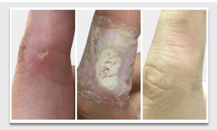 你不得不看的「甲疣」3.0 经典案例 - 知乎