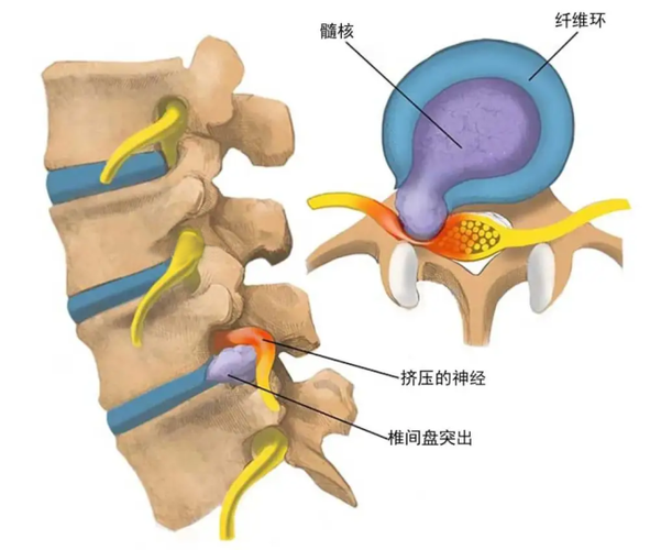 腰45腰5骶1椎間盤突出,是指腰椎纖維環破裂,髓核突入椎管,壓迫硬膜囊