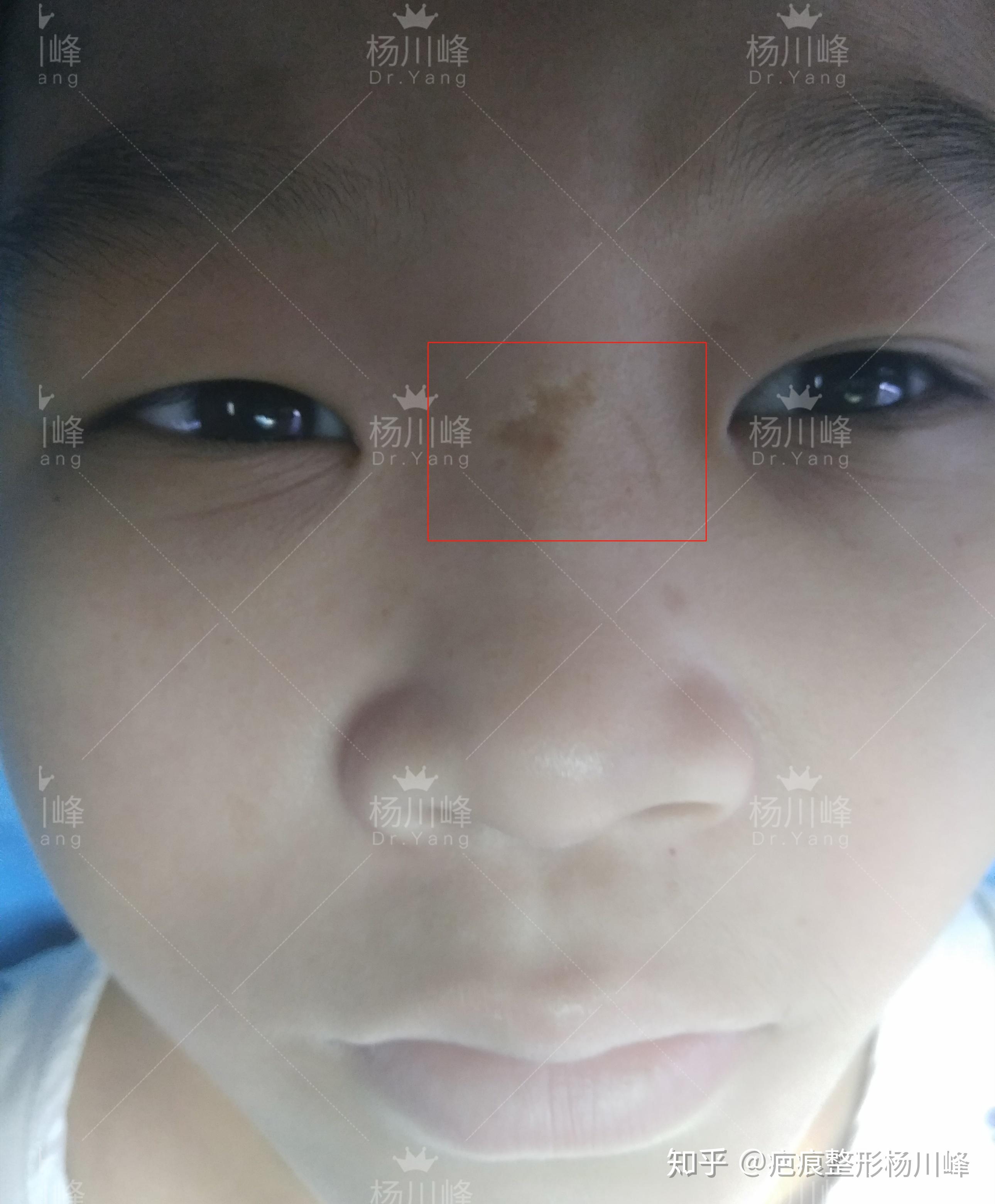 鼻翼疤痕修复+鼻槛中部缺损修复-杨杰-爱问医生