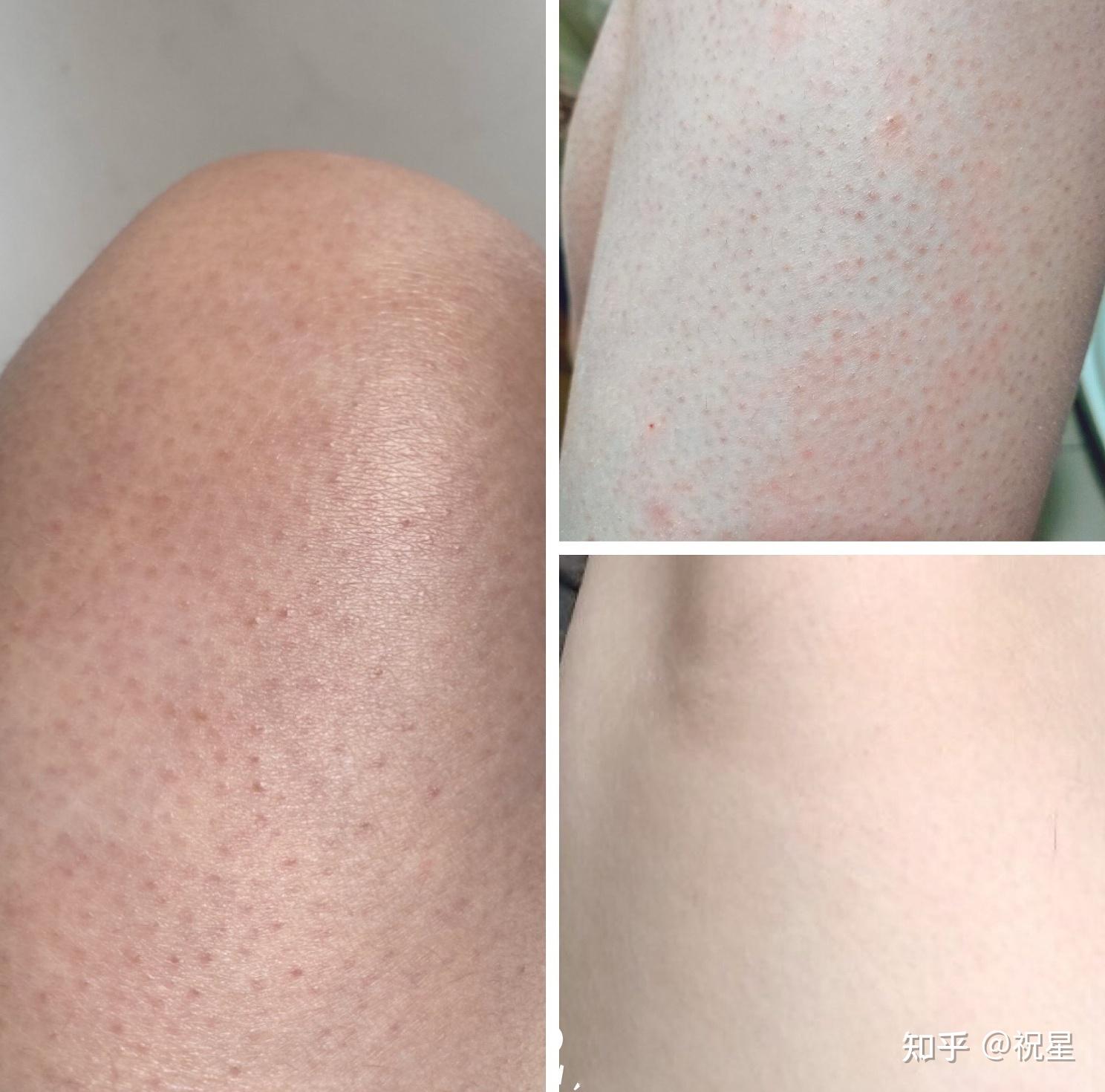 去鸡皮用什么好?