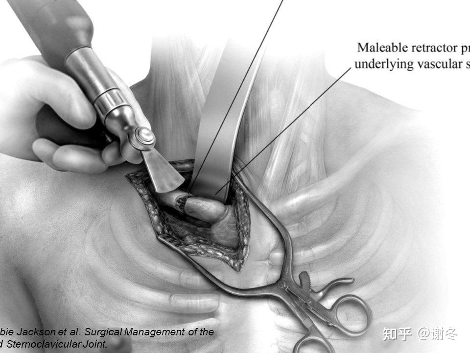 胸锁关节感染的外科治疗