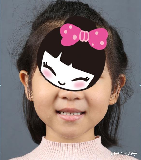 缘分儿童牙齿早期干预矫正姐妹俩跟着郭医生从上海九院到爱彼齐口腔