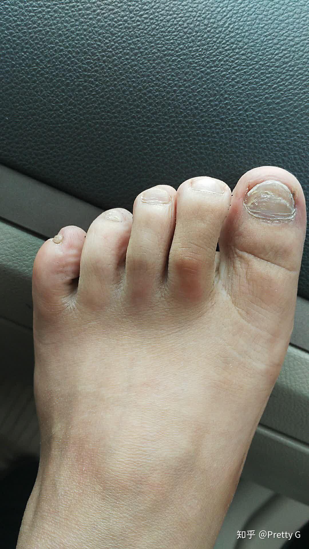 畸形脚指甲恢复过程 - 知乎