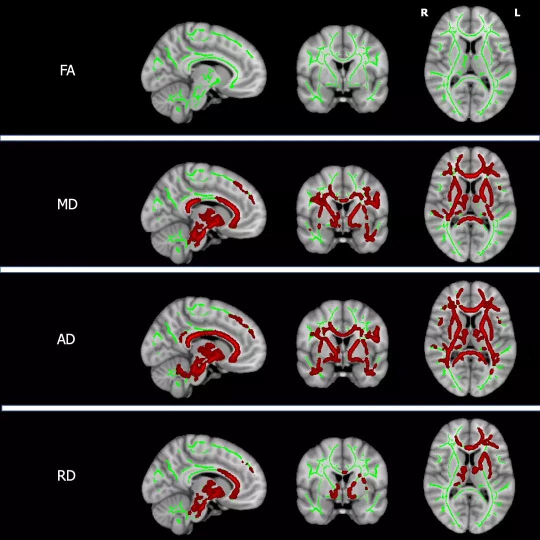 Brain:Wilson病脑损伤的神经影像特征—一项多模态全脑MRI研究 - 知乎