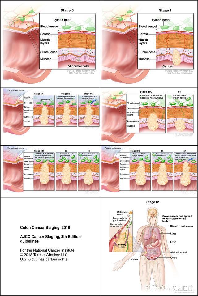 直肠癌分期图及生存图图片