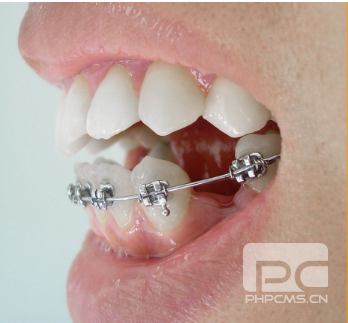 湛江致美口腔-龅牙矫正需要多少钱