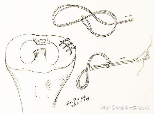 实用干货!滑线结打结技巧集锦,医生值得收藏 - 知乎