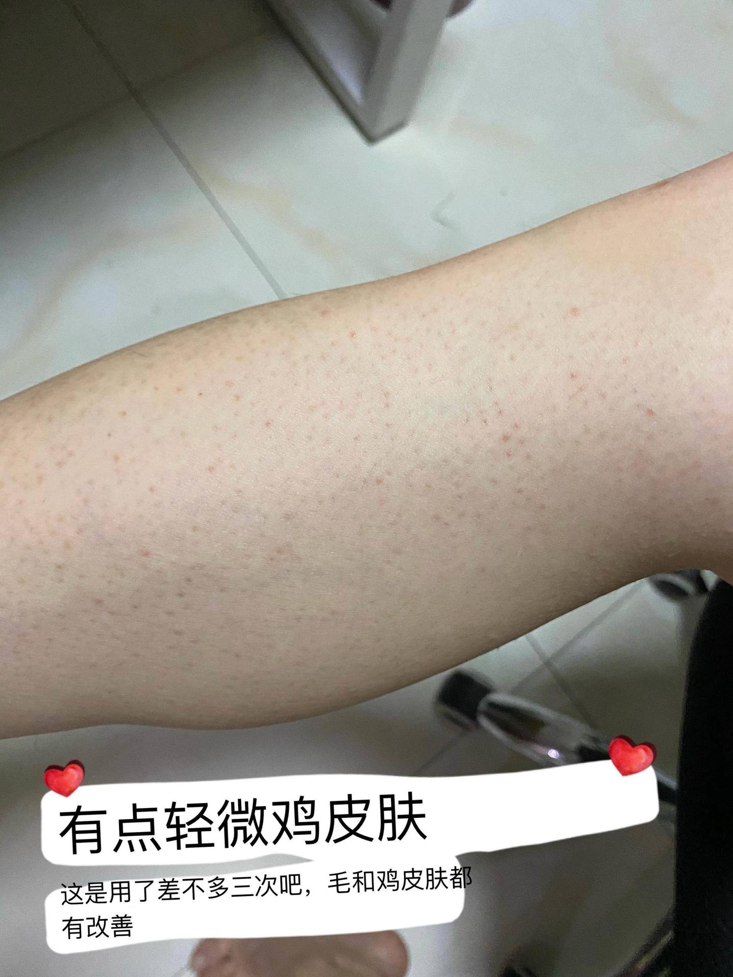 脱毛仪可以祛鸡皮肤吗(脱毛仪可以祛鸡皮肤吗怎么用)