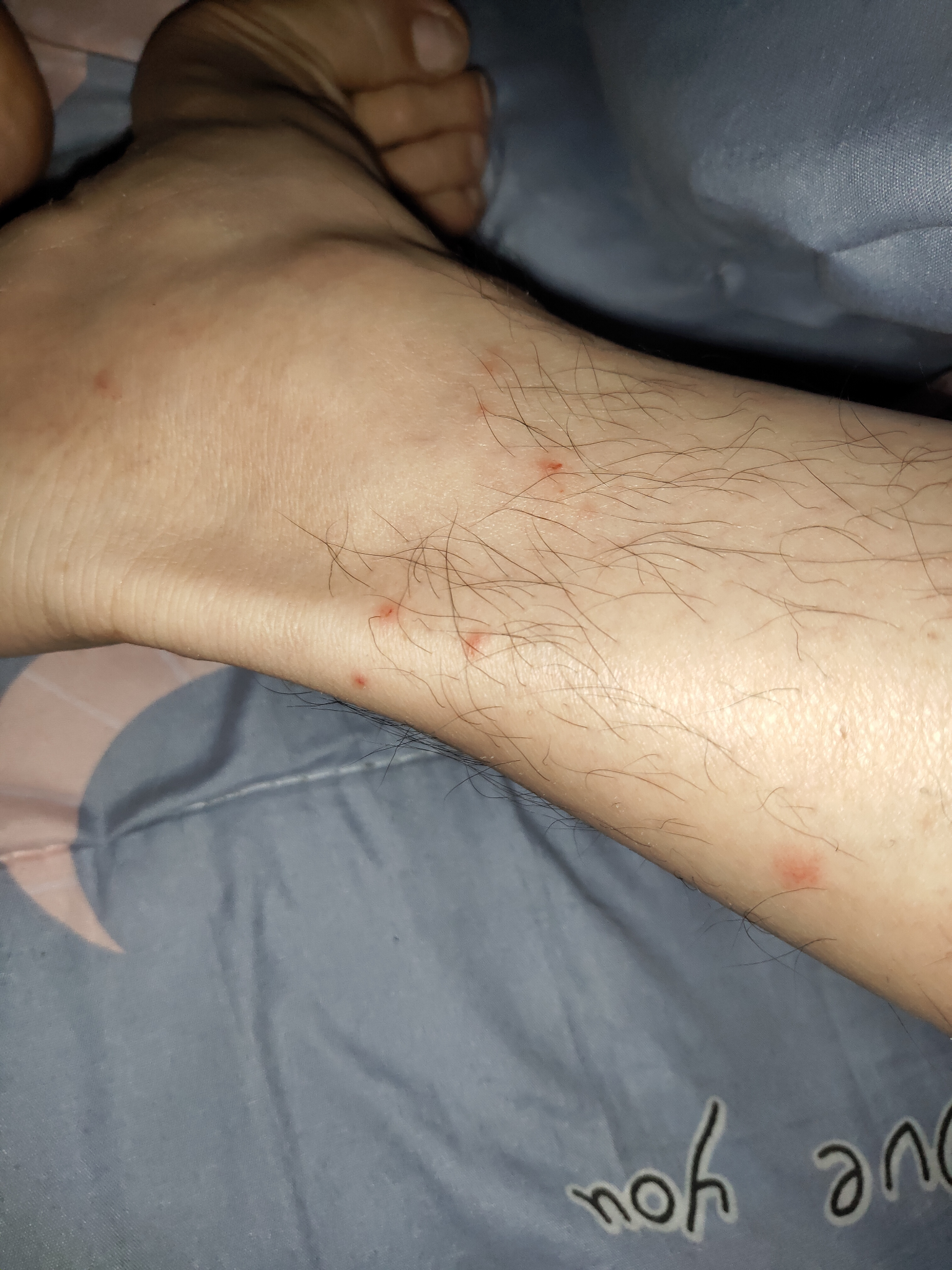 脚腕周围出了一圈疙瘩,并且很痒